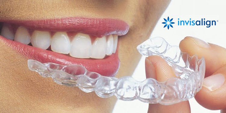 Invisalign: o que é, vantagens e preço  Tratamento odontologico, Aparelho  ortodontico, Tratamento ortodôntico